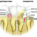  Maladie parodontale